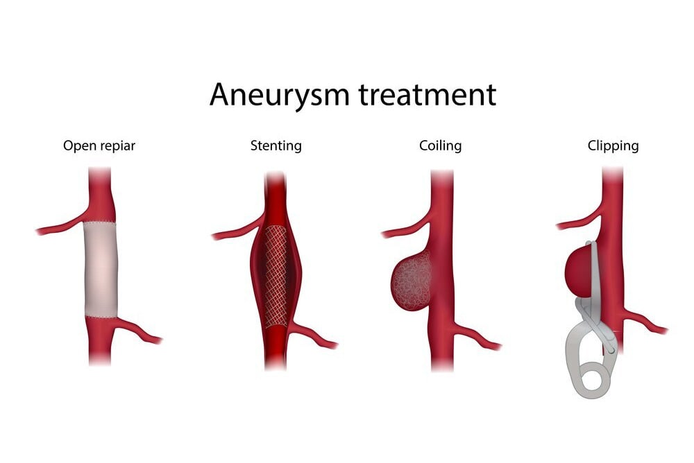 Brain Aneurysm Clipping